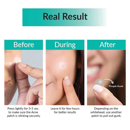 SOME BY MI 30 Days Miracle Clear Spot Patch  18 pcs